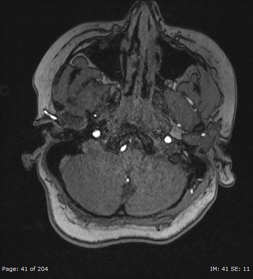 Balo concentric sclerosis (Radiopaedia 61637-69636 Axial MRA 41).jpg