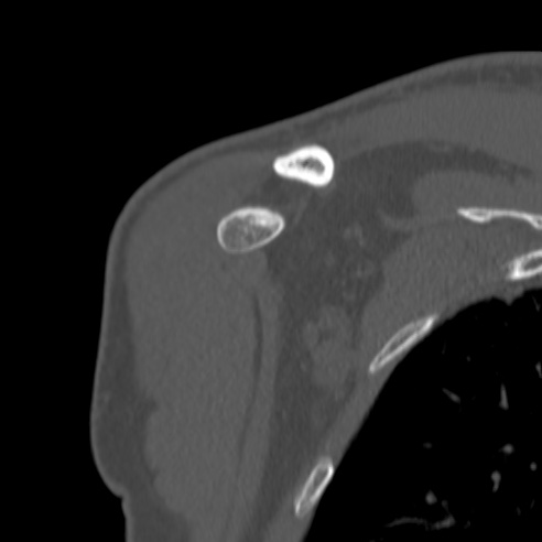 Bankart lesion (Radiopaedia 57256-64185 Coronal bone window 9).jpg