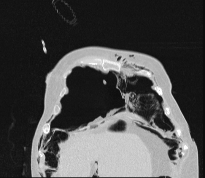 Barotrauma due to mechanical ventilation (Radiopaedia 28079-28336 Coronal lung window 17).jpg