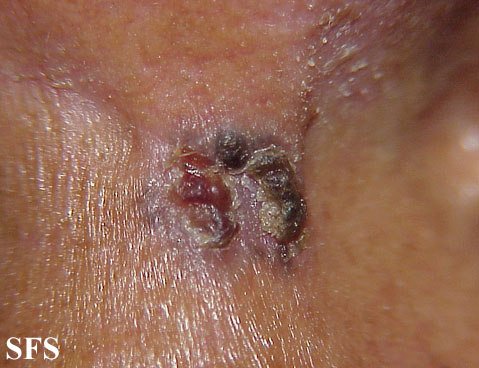 Basal Cell Carcinoma (Dermatology Atlas 56).jpg