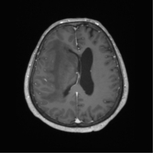 Basal ganglia metastasis (Radiopaedia 78928-91828 Axial T1 C+ 47).png