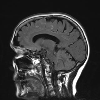 File:Base of skull chondrosarcoma (Radiopaedia 30410-31070 Sagittal FLAIR 14).jpg