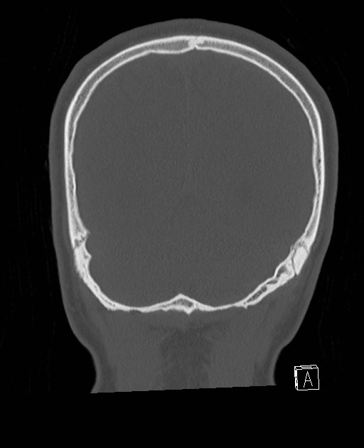 Base of skull fracture with bilateral Le Fort fractures (Radiopaedia 47094-51638 Coronal bone window 20).jpg