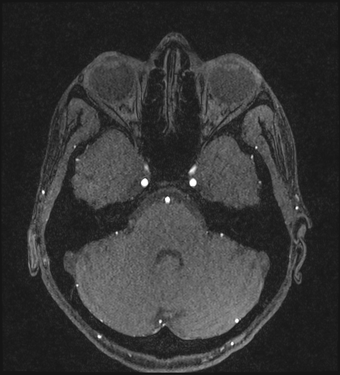 Basilar artery perforator aneurysm (Radiopaedia 82455-97733 Axial MRA 73).jpg