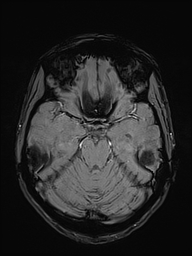 Basilar artery perforator aneurysm (Radiopaedia 82455-97733 Axial SWI 19).jpg