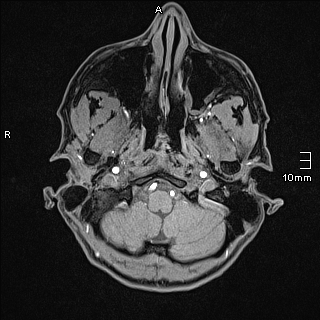 Basilar artery perforator aneurysm (Radiopaedia 82455-99523 F 4).jpg