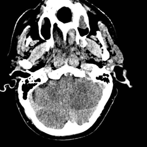 File:Basilar artery thrombosis (Radiopaedia 53351-59333 Axial non-contrast 32).jpg