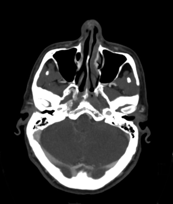 Basilar artery thrombosis and ascending transtentorial herniation (Radiopaedia 84759-100360 B 48).jpg