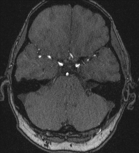 Basilar tip aneurysm (Radiopaedia 26504-26632 MRA 64).jpg