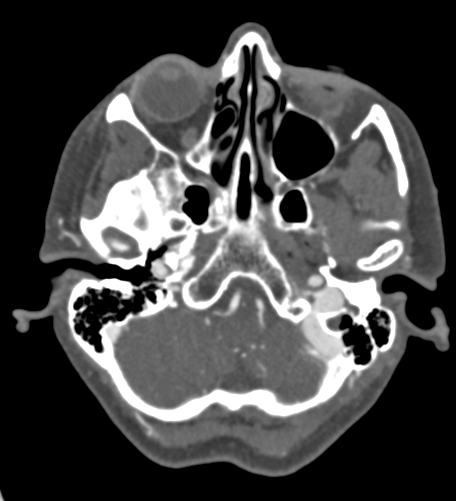 Basilar tip aneurysm with coiling (Radiopaedia 53912-60086 A 28).jpg