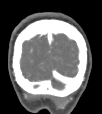Basilar tip aneurysm with coiling (Radiopaedia 53912-60086 B 149).jpg