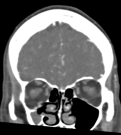 Basilar tip aneurysm with coiling (Radiopaedia 53912-60086 B 26).jpg