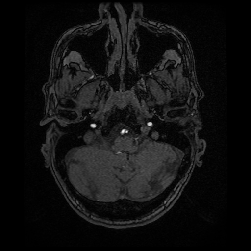 Basilar top and left middle cerebral artery aneurysm (Radiopaedia 61965-70031 Axial MRA 20).jpg