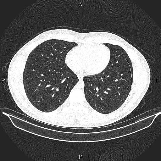 Beam hardening and ring artifacts (Radiopaedia 85323-100915 Axial lung window 53).jpg