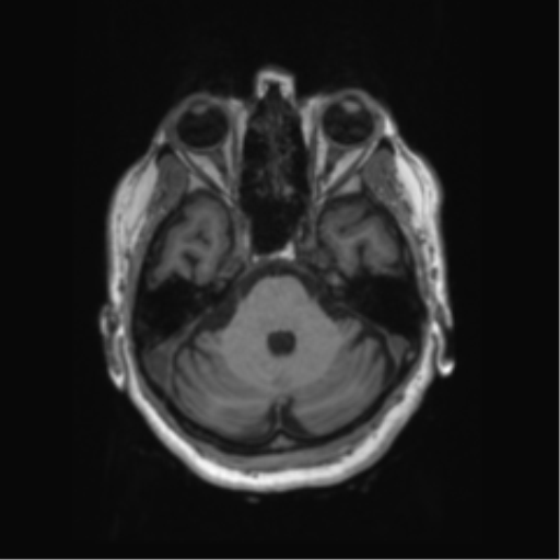 Behavioral variant frontotemporal dementia and late onset schizophrenia (Radiopaedia 52197-58083 Axial T1 81).png