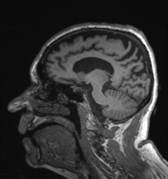 Behavioral variant frontotemporal dementia and late onset schizophrenia (Radiopaedia 52197-58083 Sagittal T1 38).png