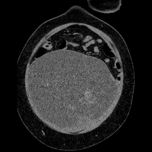 File:Benign leiomyoma with hydropic features (Radiopaedia 89250-106130 B 31).jpg