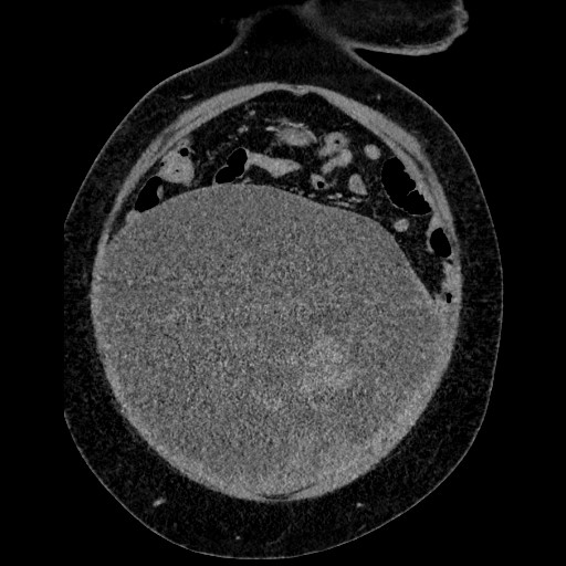 Benign leiomyoma with hydropic features (Radiopaedia 89250-106130 B 32).jpg