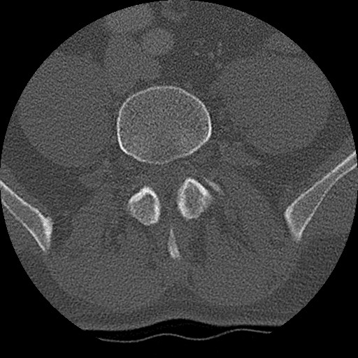 Benign post-traumatic pseudopneumoperitoneum (Radiopaedia 71199-81495 Axial bone window 261).jpg
