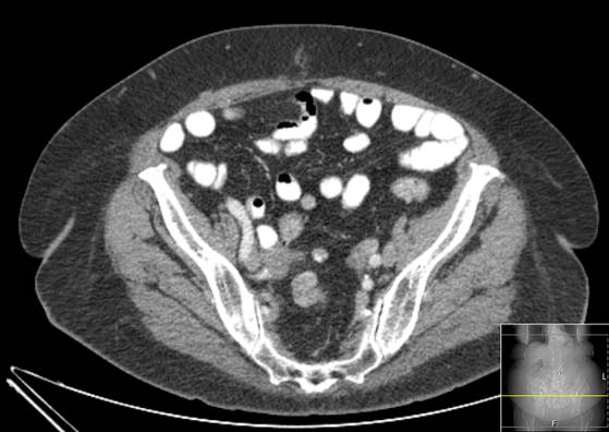 Bicameral celiacomesenteric aneurysm (Radiopaedia 55766-62327 A 55).jpg