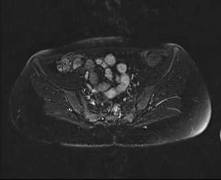 File:Bicornuate bicollis uterus (Radiopaedia 61626-69616 Axial PD fat sat 11).jpg
