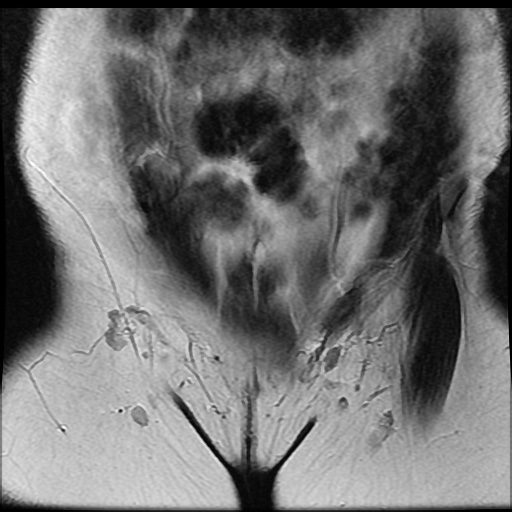 File:Bicornuate uterus (Radiopaedia 51676-57472 Coronal T2 5).jpg