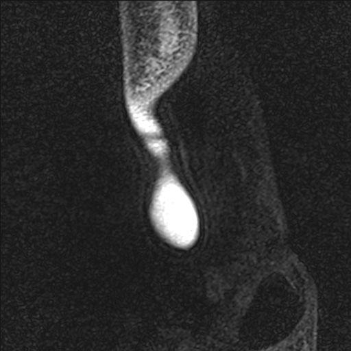 Bilateral Achilles tendon complete tear (Radiopaedia 81344-95051 Sagittal WE - Left 110).jpg