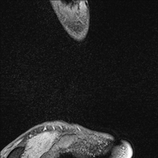 Bilateral Achilles tendon complete tear (Radiopaedia 81344-95051 Sagittal WE - Left 16).jpg