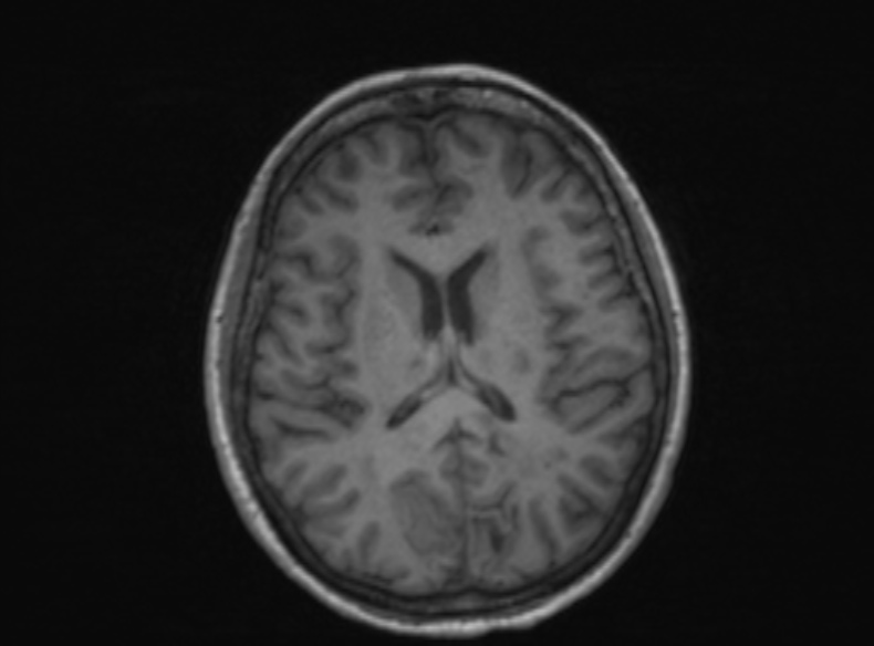 Bilateral PCA territory infarction - different ages (Radiopaedia 46200-51784 Axial T1 215).jpg