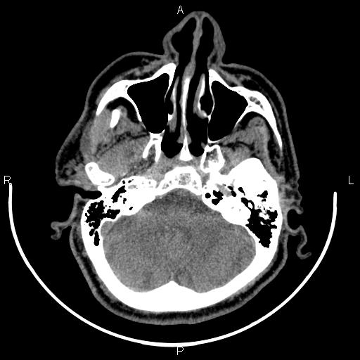 Bilateral Warthin tumors (Radiopaedia 84034-99263 Axial non-contrast 6).jpg