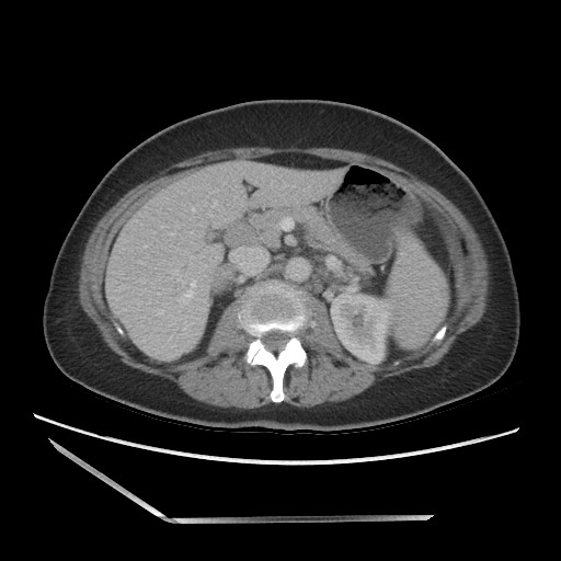 Bilateral adrenal granulocytic sarcomas (chloromas) (Radiopaedia 78375-91007 A 47).jpg