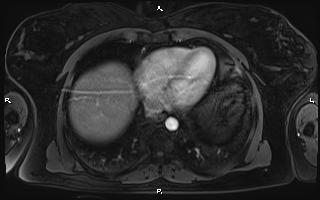Bilateral adrenal myelolipoma (Radiopaedia 63058-71537 Axial T1 C+ fat sat 10).jpg