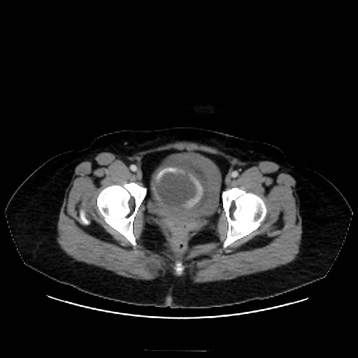 Bilateral adrenal thrombosis (Radiopaedia 58182-65256 A 74).jpg