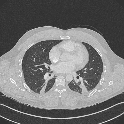 Bilateral atelectasis (Radiopaedia 48666-53675 Axial lung window 63).jpg