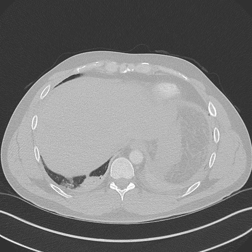 Bilateral atelectasis (Radiopaedia 48666-53675 Axial lung window 95).jpg