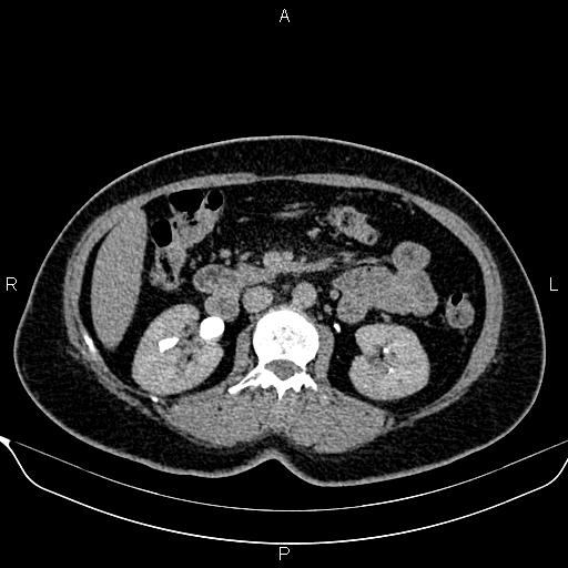 Bilateral benign adrenal adenomas (Radiopaedia 86912-103124 Axial C+ delayed 63).jpg