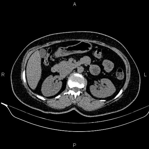 Bilateral benign adrenal adenomas (Radiopaedia 86912-103124 Axial non-contrast 46).jpg