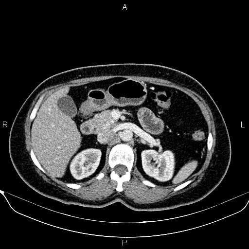 Bilateral benign adrenal adenomas (Radiopaedia 86912-103124 B 39).jpg