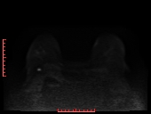 File:Bilateral breast implant rupture (Radiopaedia 24761-25027 DWI 12).jpg