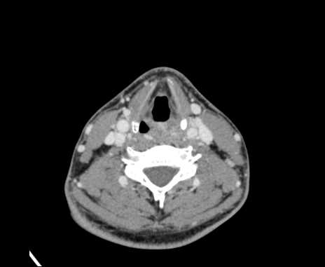Bilateral carotid body tumors (Radiopaedia 61841-69870 Axial Post contrast 68).jpg