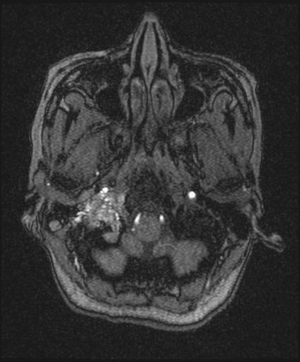 Bilateral carotid body tumors and right glomus jugulare tumor (Radiopaedia 20024-20060 Axial MRA 22).jpg