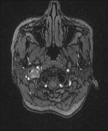 Bilateral carotid body tumors and right glomus jugulare tumor (Radiopaedia 20024-20060 Axial MRA 7).jpg