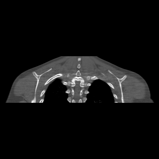 Bilateral chronic posterior shoulder dislocation (Radiopaedia 39213-41452 Coronal bone window 50).jpg