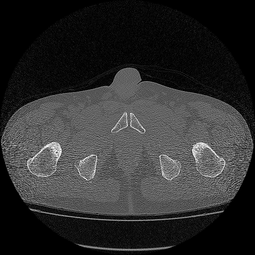 Bilateral femoral neck stress fractures (Radiopaedia 28666-28954 Axial bone window 68).png