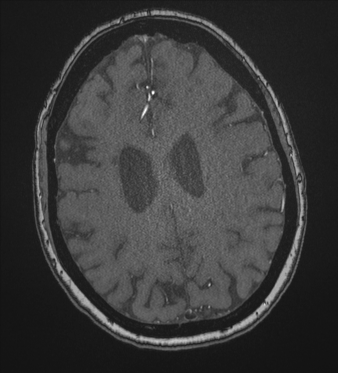 Bilateral fetal posterior communicating arteries (Radiopaedia 41286-44102 Axial MRA 160).png