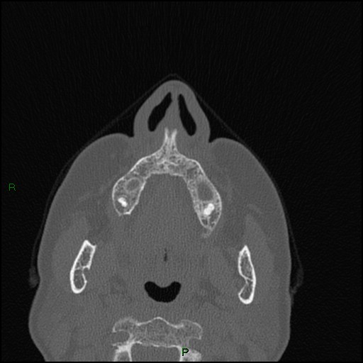 Bilateral frontal mucoceles (Radiopaedia 82352-96454 Axial bone window 238).jpg