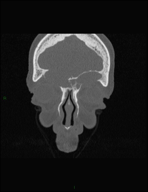 Bilateral frontal mucoceles (Radiopaedia 82352-96454 Coronal 73).jpg