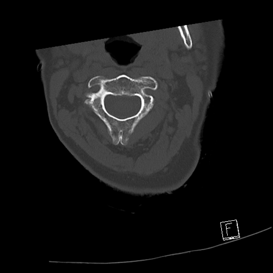 Bilateral occipital condyle fractures (type 3) (Radiopaedia 87672-104086 Axial bone window 24).jpg