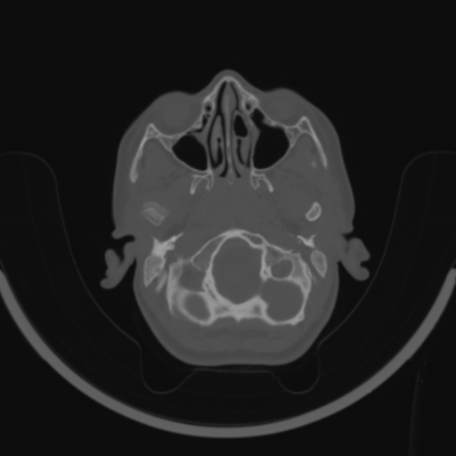 Bilateral otosclerosis (Radiopaedia 57237-64157 C 13).jpg