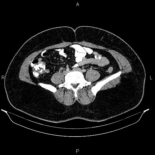 Bilateral ovarian dermoid cysts (Radiopaedia 85785-101603 A 71).jpg